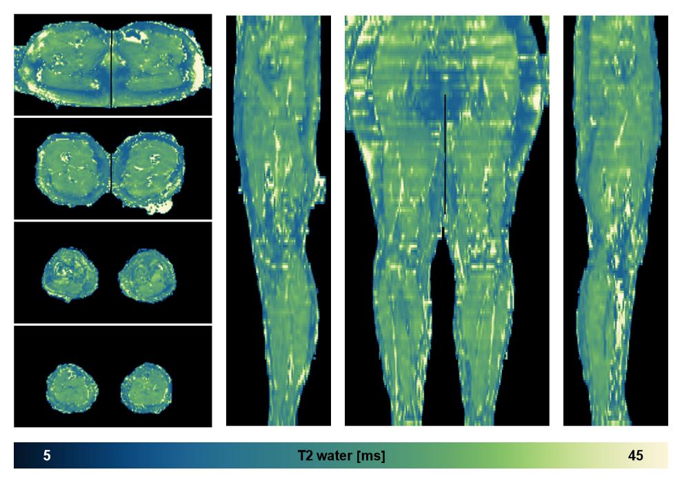 The water only T2 relaxation time of the lower extremity obtained from multi echo spin echo t2 mapping with EPG based reconstruction.