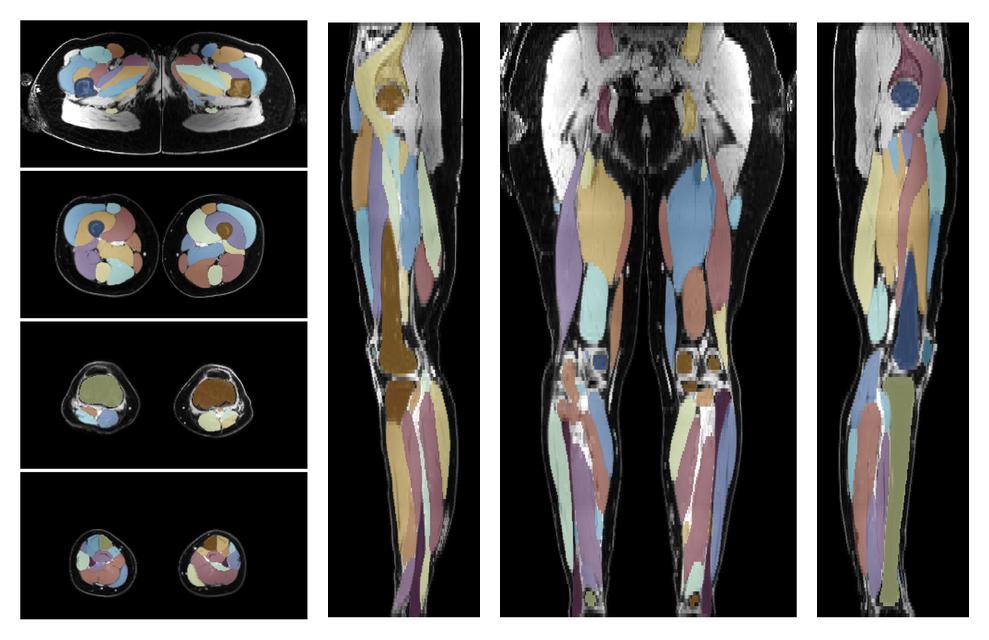Overlay of automated muscle segmentation labels on dixon water image.