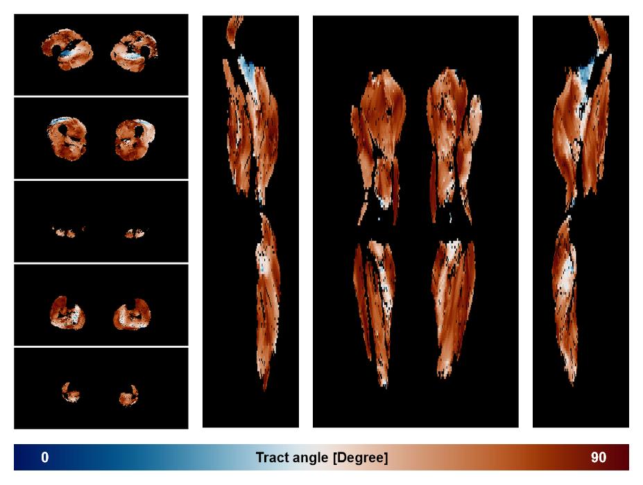 Muscle fiber tract angle map based on whole leg DTI based fiber tractography.