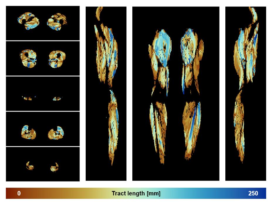 Muscle fiber tract length map based on whole leg DTI based fiber tractography.