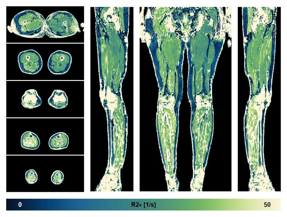 The R2 star relaxation time of the lower extremity obtained from the dixon reconstruction for muscle water fat quantification.