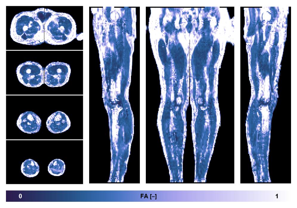 IVIM corrected whole leg muscle fractional anisotropy obtained from diffusion tensor imaging.