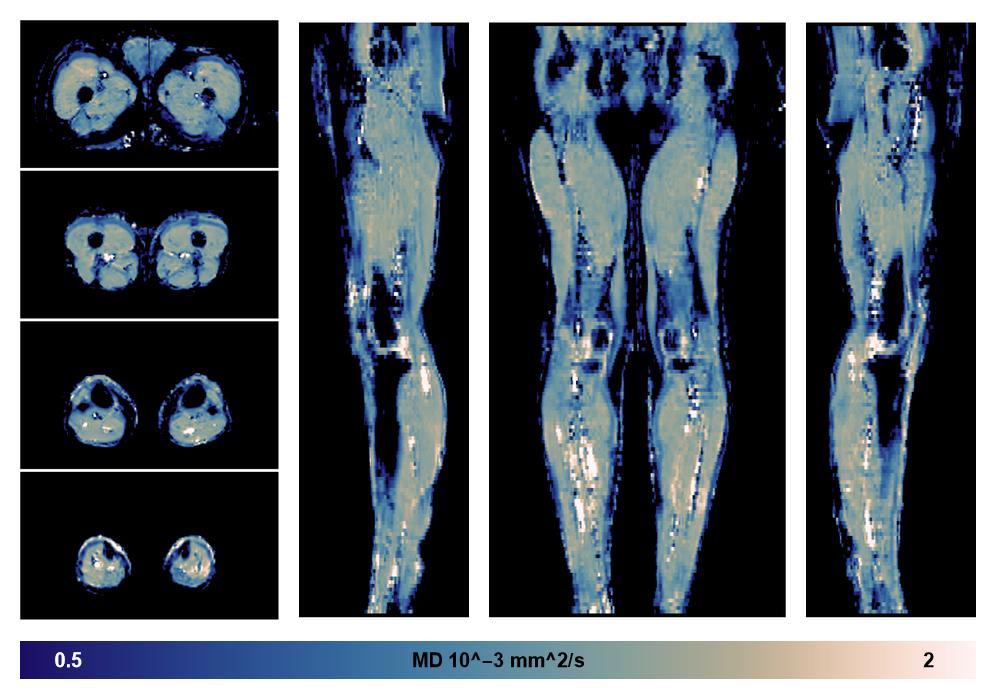 IVIM corrected whole leg muscle mean diffusivity obtained from diffusion tensor imaging.