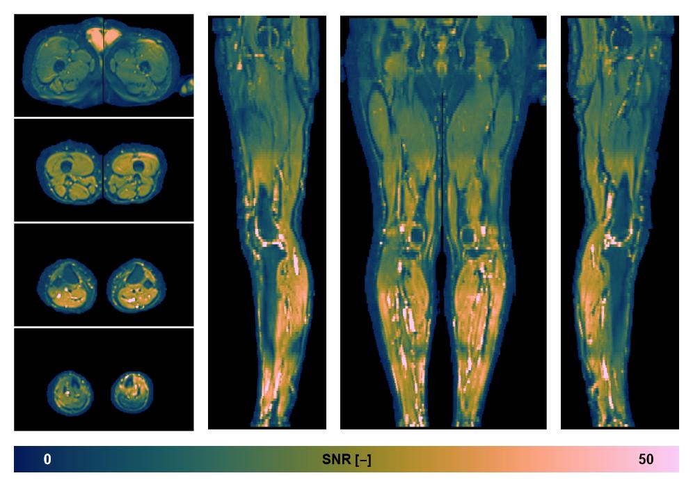 SNR distribution of the unweighted diffusion data.
