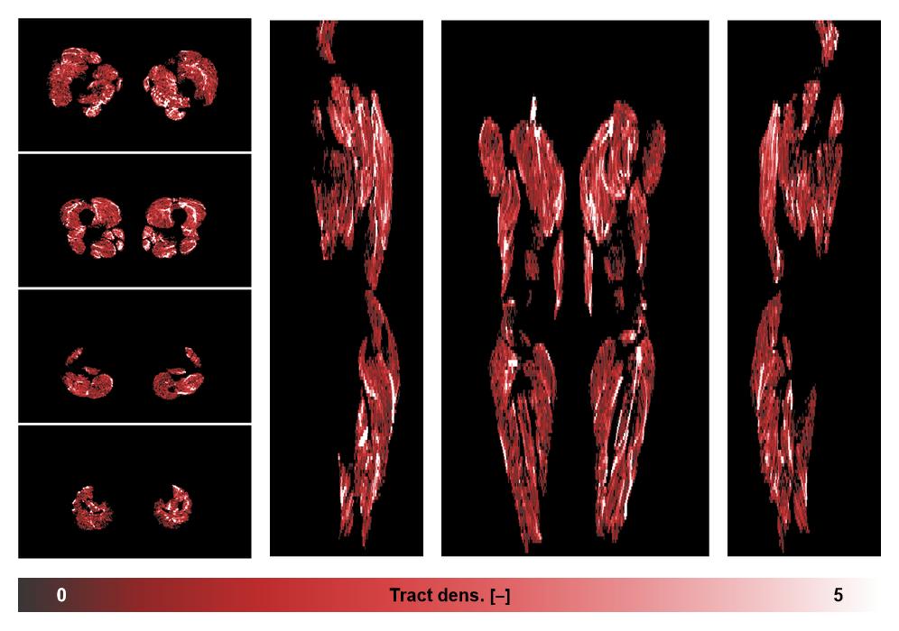 Muscle fiber tract density map based on whole leg DTI based fiber tractography.
