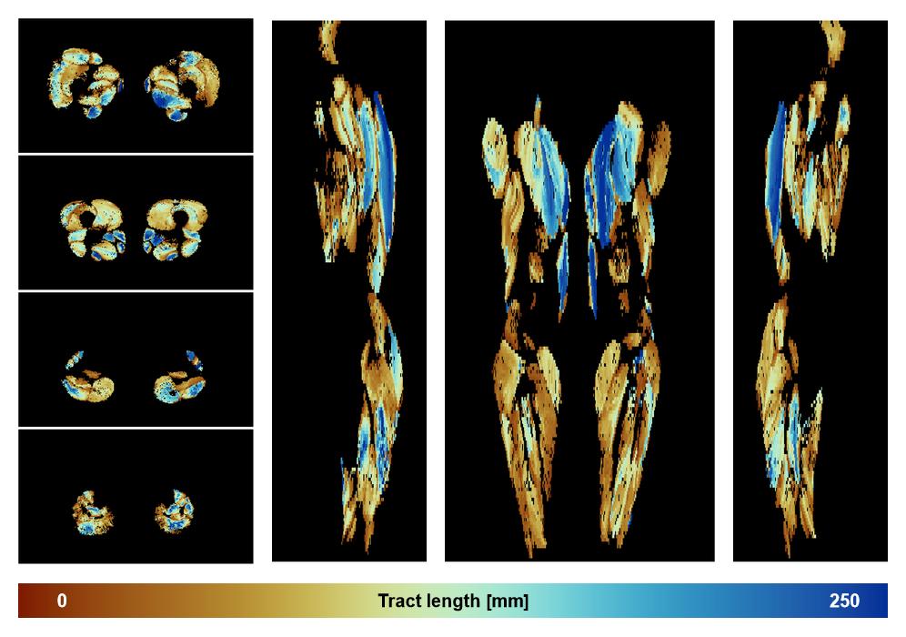 Muscle fiber tract length map based on whole leg DTI based fiber tractography.