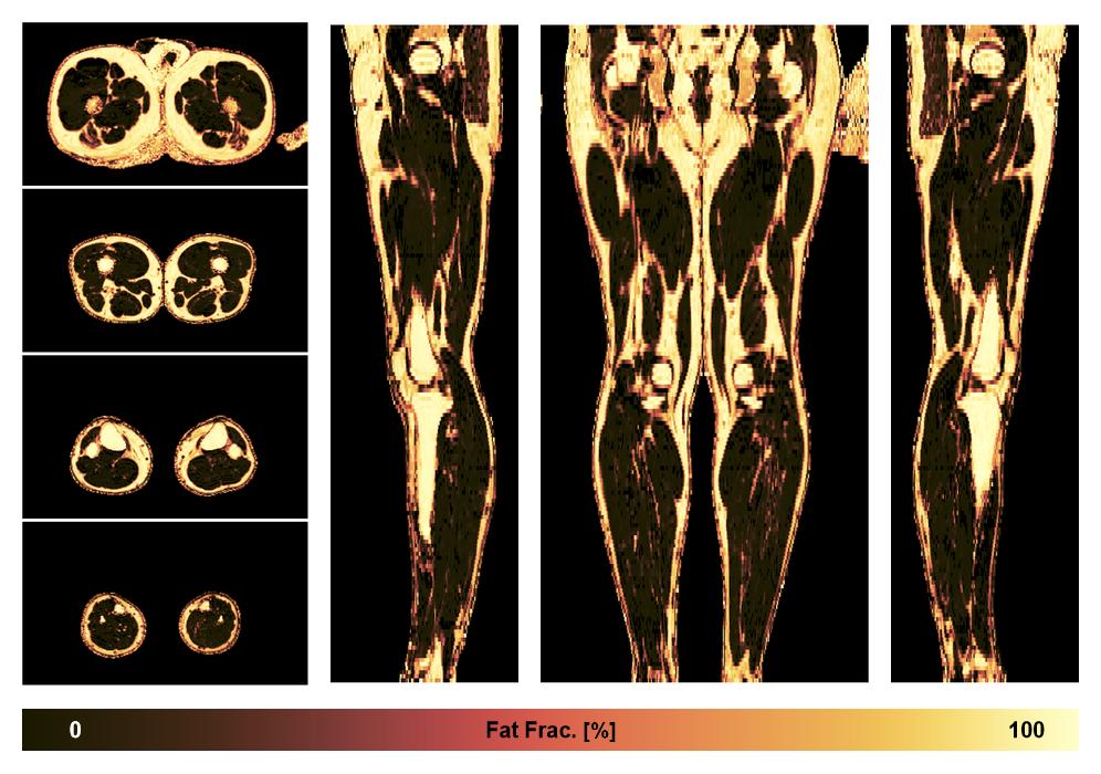 The fat fraction of the lower extremity obtained from the dixon reconstruction for muscle water fat quantification.