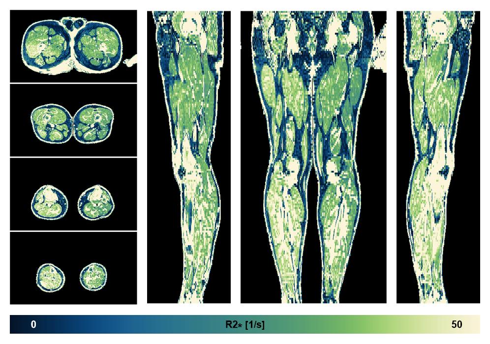 The R2 star relaxation time of the lower extremity obtained from the dixon reconstruction for muscle water fat quantification.