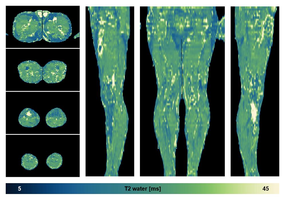 The water only T2 relaxation time of the lower extremity obtained from multi echo spin echo t2 mapping with EPG based reconstruction.