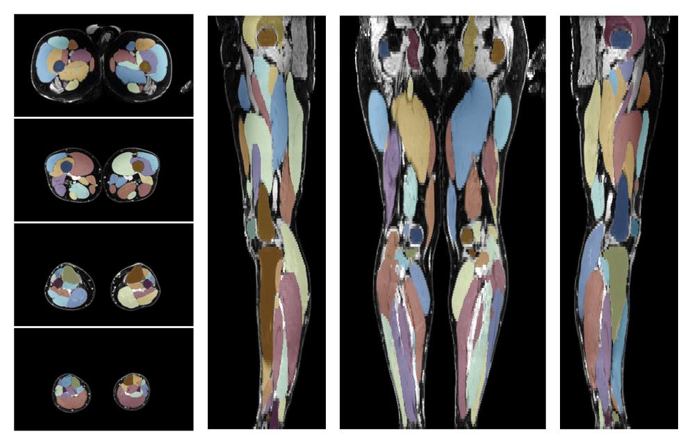 Overlay of automated muscle segmentation labels on dixon water image.