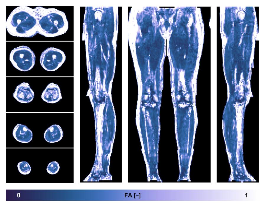 IVIM corrected whole leg muscle fractional anisotropy obtained from diffusion tensor imaging.