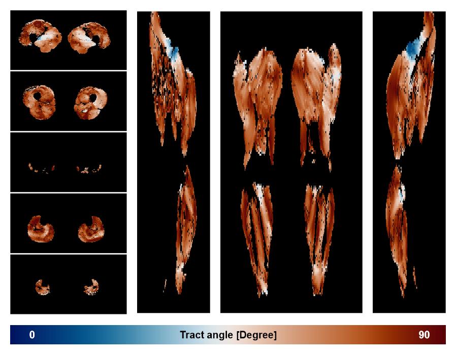 Muscle fiber tract angle map based on whole leg DTI based fiber tractography.