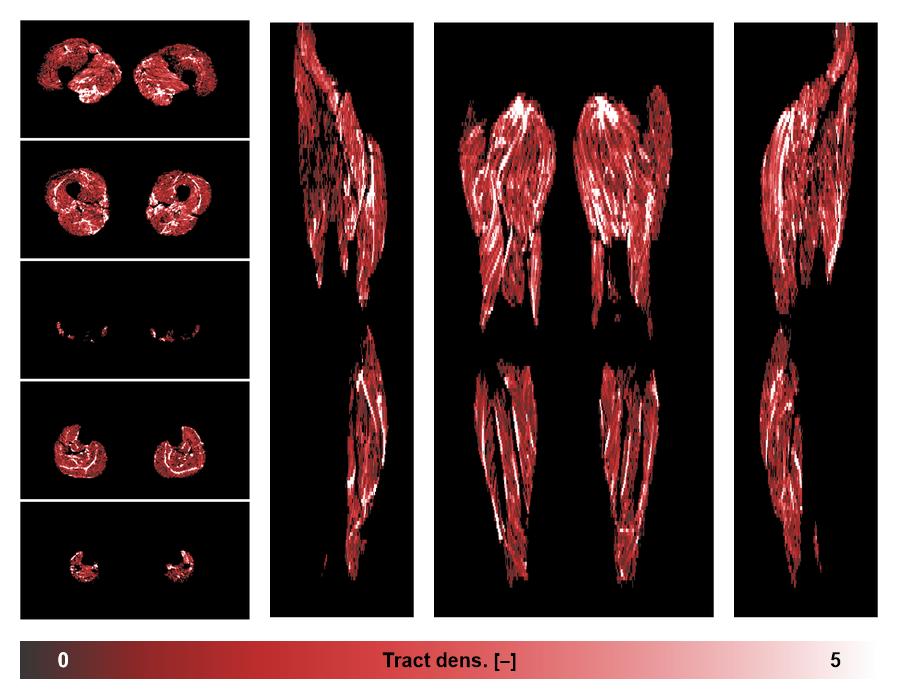 Muscle fiber tract density map based on whole leg DTI based fiber tractography.