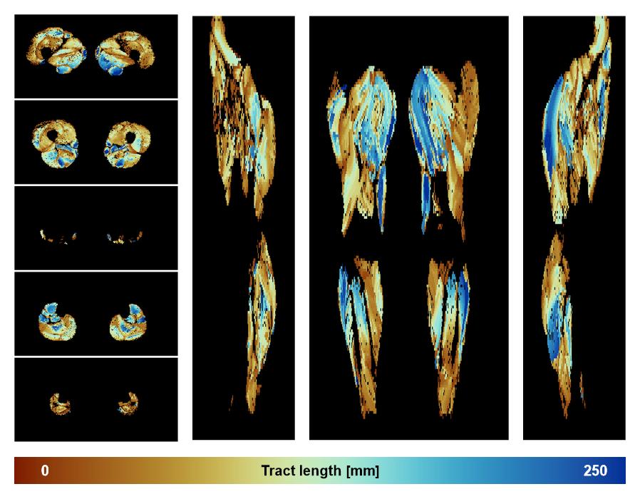 Muscle fiber tract length map based on whole leg DTI based fiber tractography.