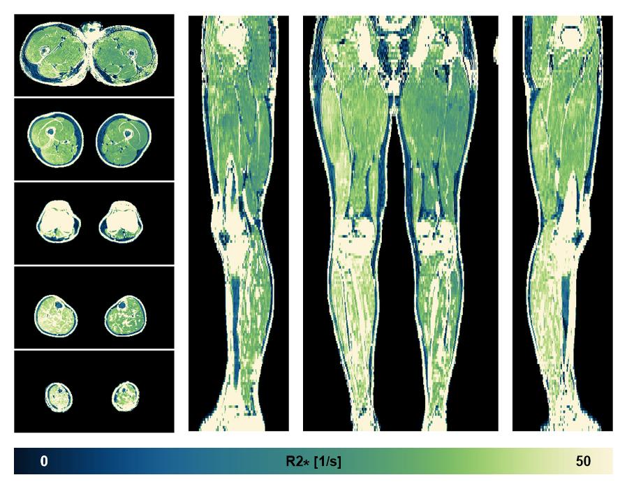The R2 star relaxation time of the lower extremity obtained from the dixon reconstruction for muscle water fat quantification.