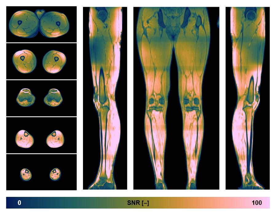 The SNR distribution of the dixon data.