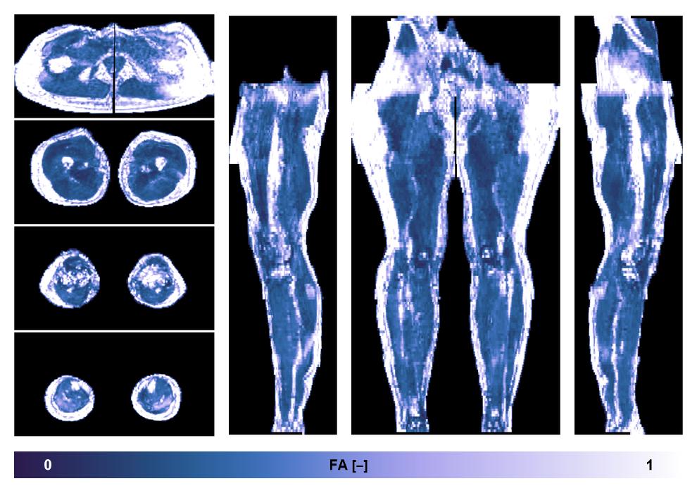 IVIM corrected whole leg muscle fractional anisotropy obtained from diffusion tensor imaging.