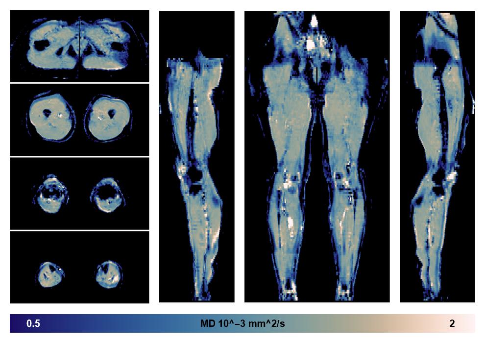 IVIM corrected whole leg muscle mean diffusivity obtained from diffusion tensor imaging.