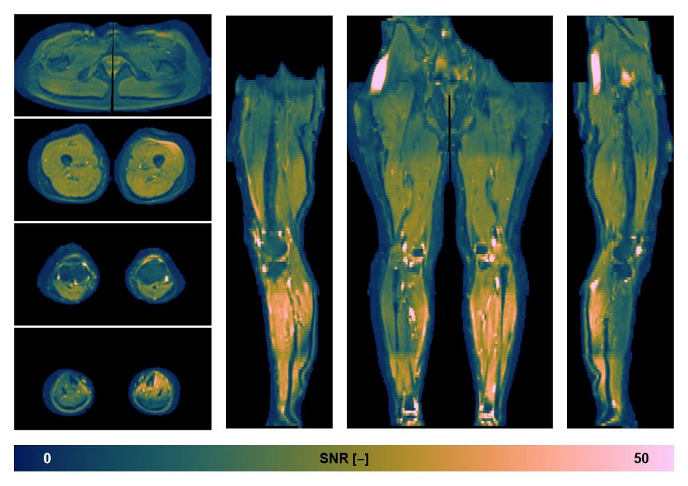 SNR distribution of the unweighted diffusion data.