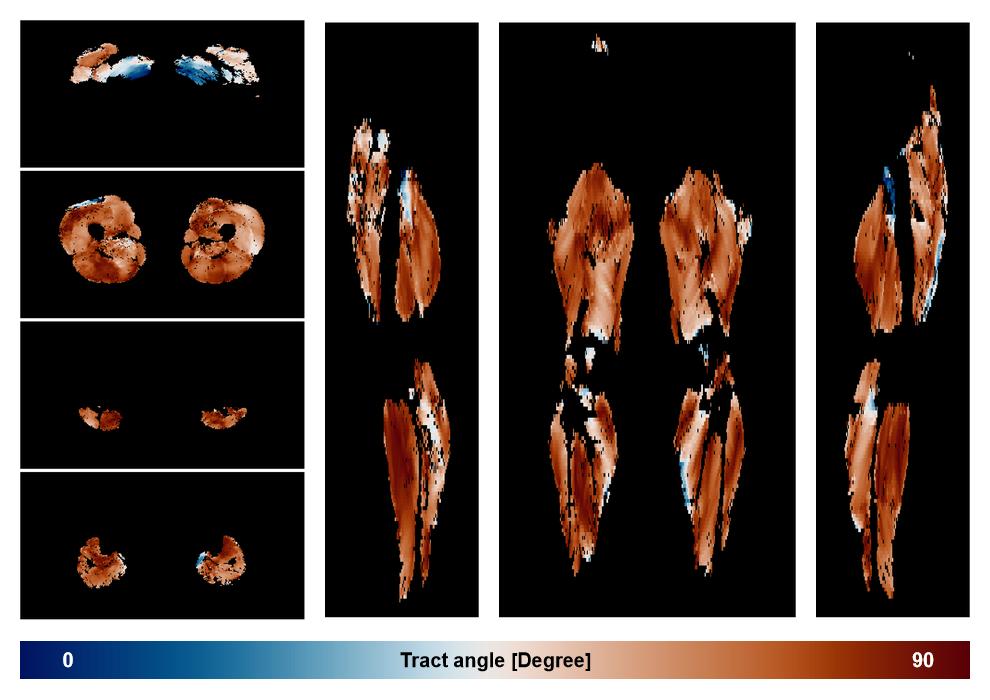 Muscle fiber tract angle map based on whole leg DTI based fiber tractography.