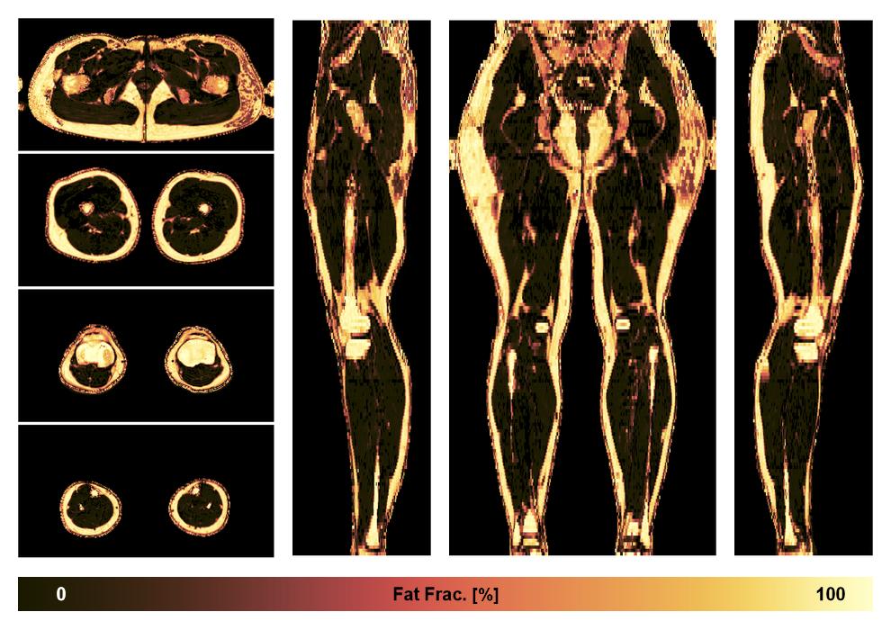 The fat fraction of the lower extremity obtained from the dixon reconstruction for muscle water fat quantification.