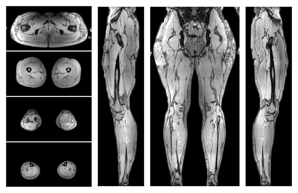 The out-phase image of the dixon reconstruction for water fat quantification.