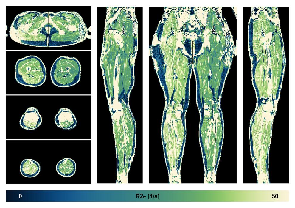 The R2 star relaxation time of the lower extremity obtained from the dixon reconstruction for muscle water fat quantification.