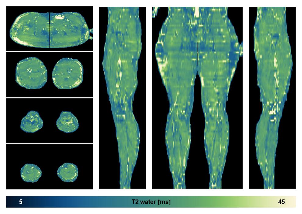 The water only T2 relaxation time of the lower extremity obtained from multi echo spin echo t2 mapping with EPG based reconstruction.