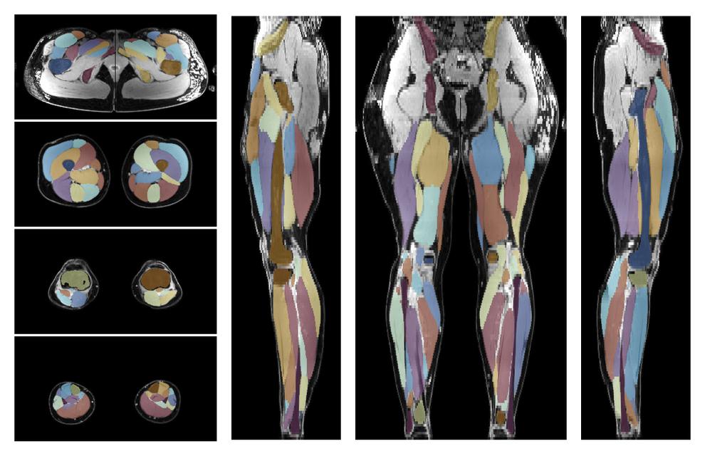 Overlay of automated muscle segmentation labels on dixon water image.