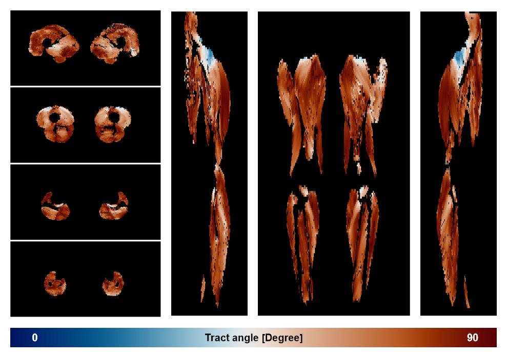 Muscle fiber tract angle map based on whole leg DTI based fiber tractography.