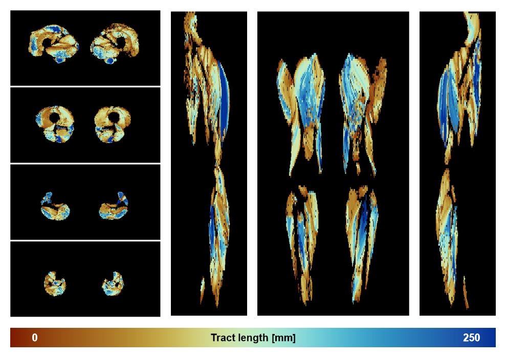 Muscle fiber tract length map based on whole leg DTI based fiber tractography.