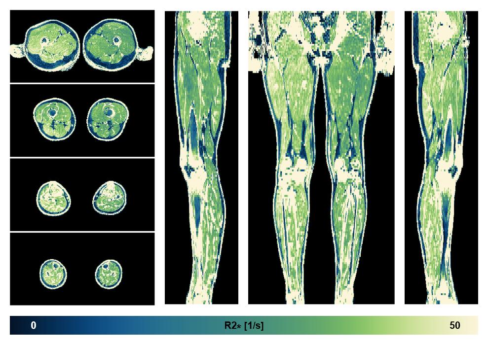The R2 star relaxation time of the lower extremity obtained from the dixon reconstruction for muscle water fat quantification.