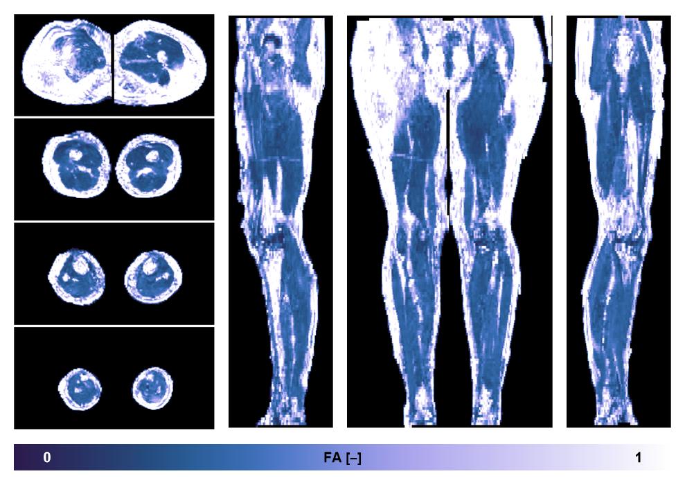 IVIM corrected whole leg muscle fractional anisotropy obtained from diffusion tensor imaging.