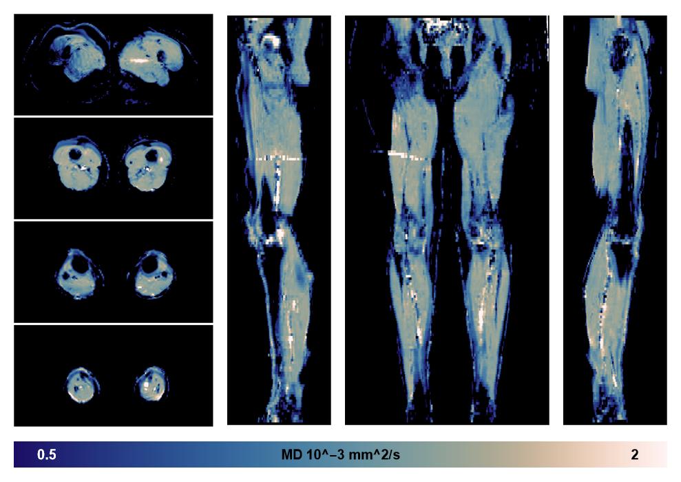 IVIM corrected whole leg muscle mean diffusivity obtained from diffusion tensor imaging.