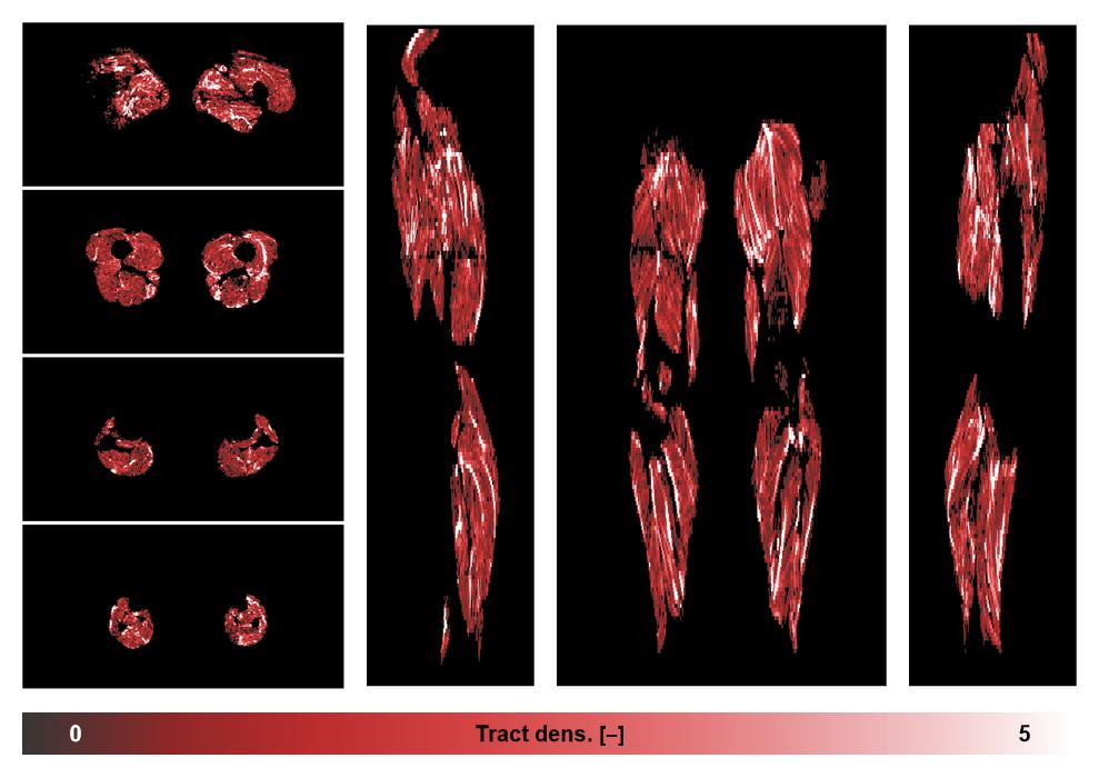 Muscle fiber tract density map based on whole leg DTI based fiber tractography.