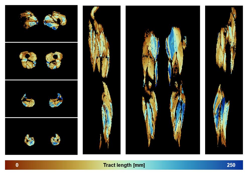 Muscle fiber tract length map based on whole leg DTI based fiber tractography.