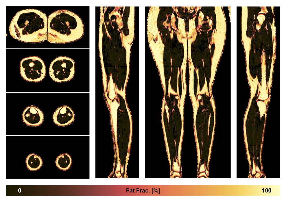 The fat fraction of the lower extremity obtained from the dixon reconstruction for muscle water fat quantification.