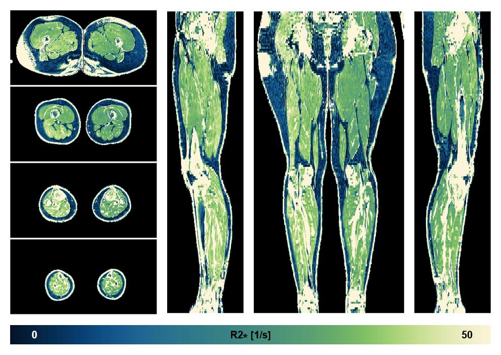 The R2 star relaxation time of the lower extremity obtained from the dixon reconstruction for muscle water fat quantification.