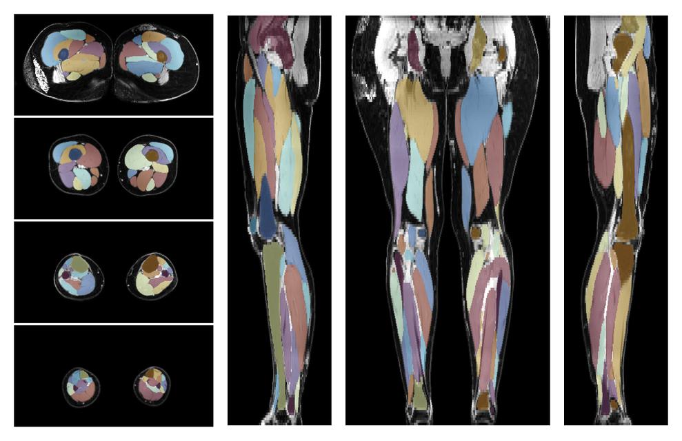 Overlay of automated muscle segmentation labels on dixon water image.