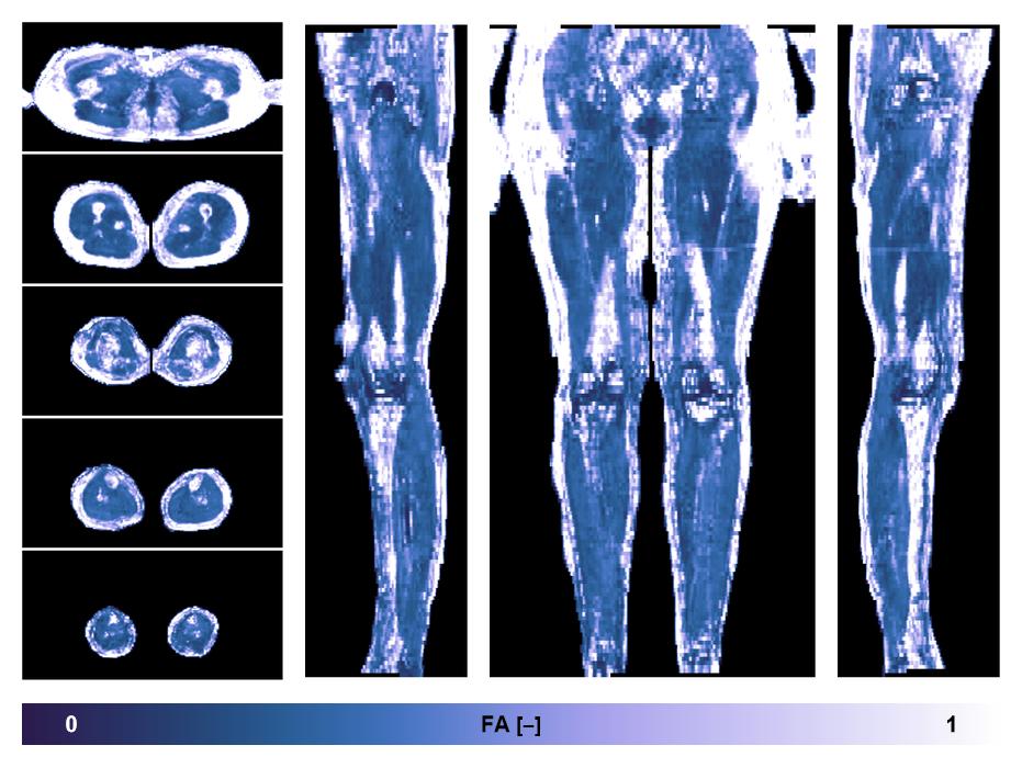 IVIM corrected whole leg muscle fractional anisotropy obtained from diffusion tensor imaging.