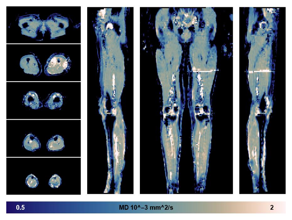IVIM corrected whole leg muscle mean diffusivity obtained from diffusion tensor imaging.