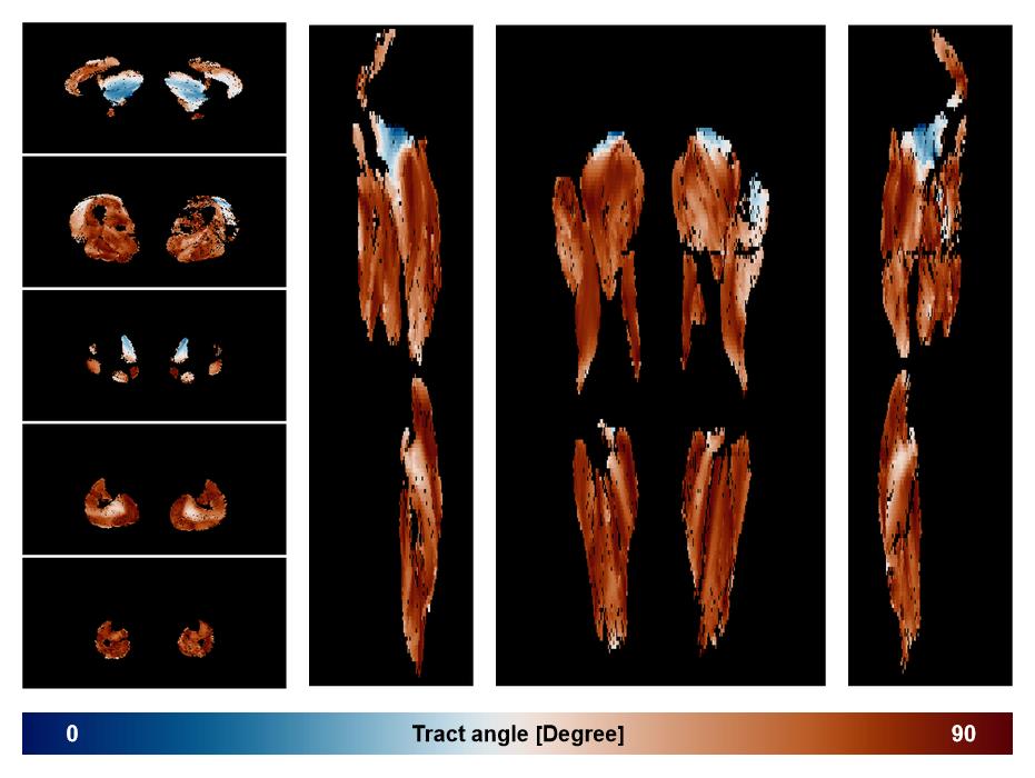 Muscle fiber tract angle map based on whole leg DTI based fiber tractography.