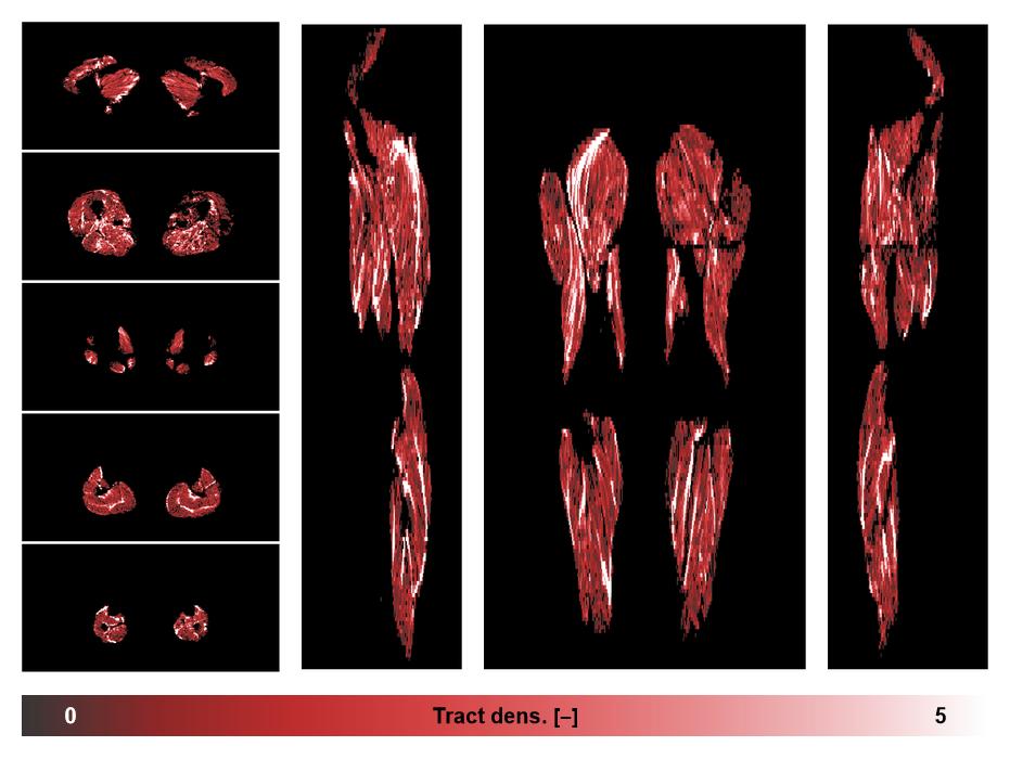 Muscle fiber tract density map based on whole leg DTI based fiber tractography.