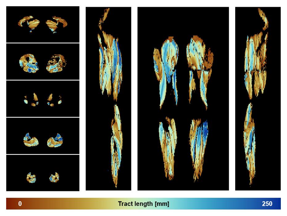 Muscle fiber tract length map based on whole leg DTI based fiber tractography.