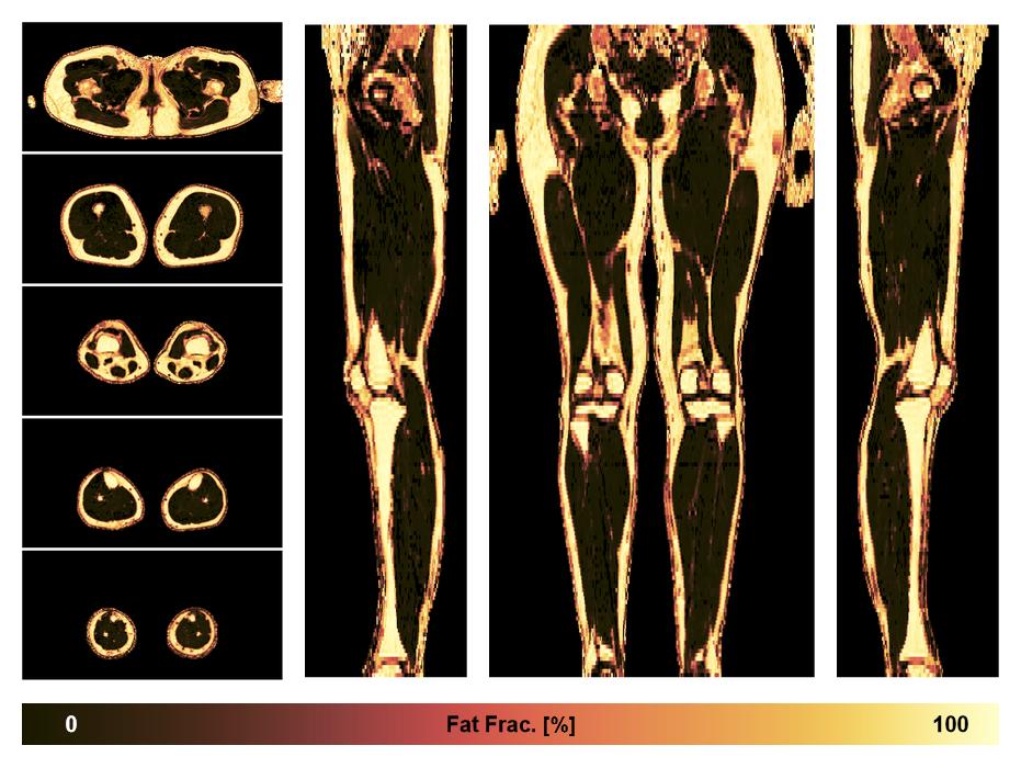 The fat fraction of the lower extremity obtained from the dixon reconstruction for muscle water fat quantification.