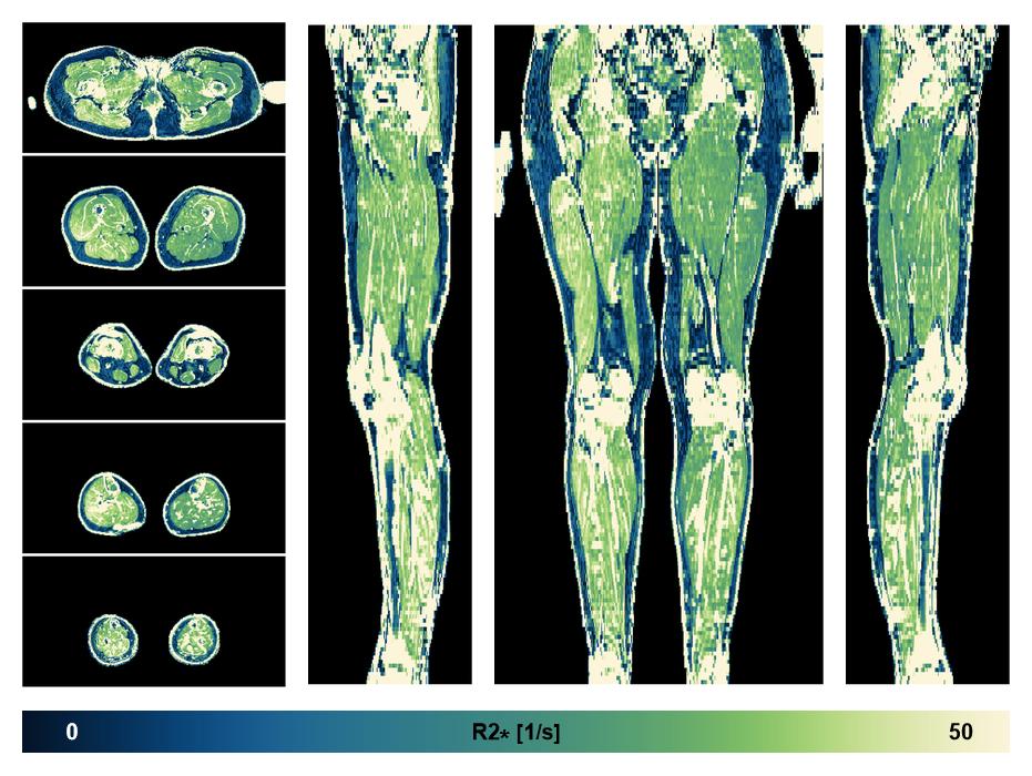 The R2 star relaxation time of the lower extremity obtained from the dixon reconstruction for muscle water fat quantification.
