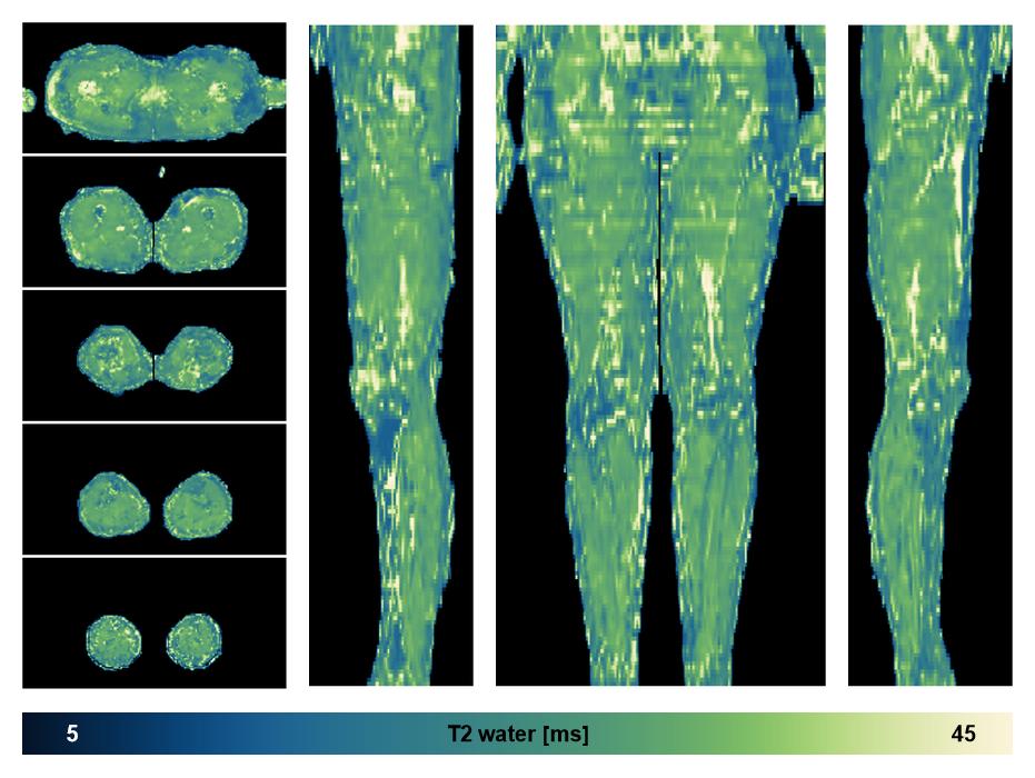 The water only T2 relaxation time of the lower extremity obtained from multi echo spin echo t2 mapping with EPG based reconstruction.