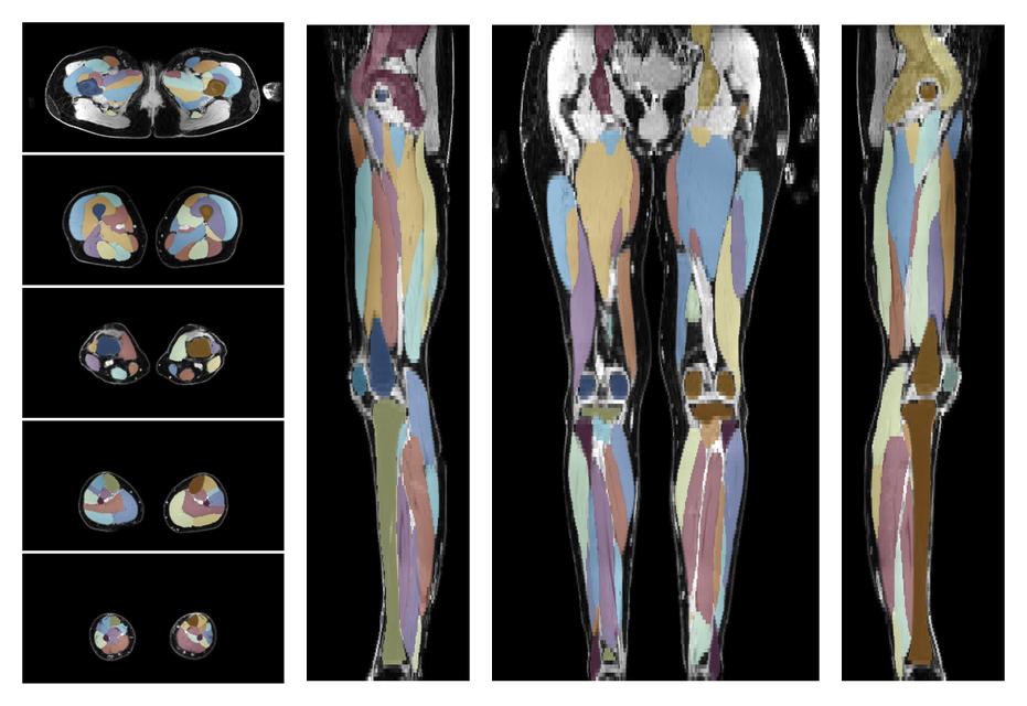 Overlay of automated muscle segmentation labels on dixon water image.