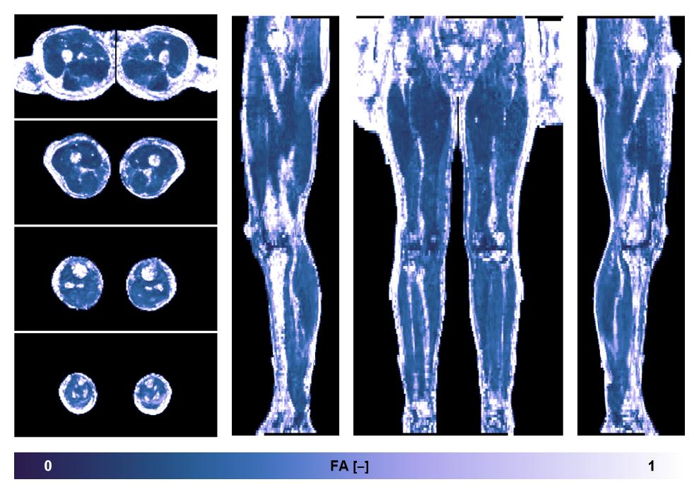 IVIM corrected whole leg muscle fractional anisotropy obtained from diffusion tensor imaging.