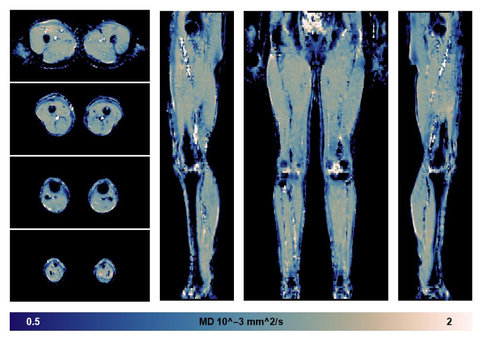 IVIM corrected whole leg muscle mean diffusivity obtained from diffusion tensor imaging.